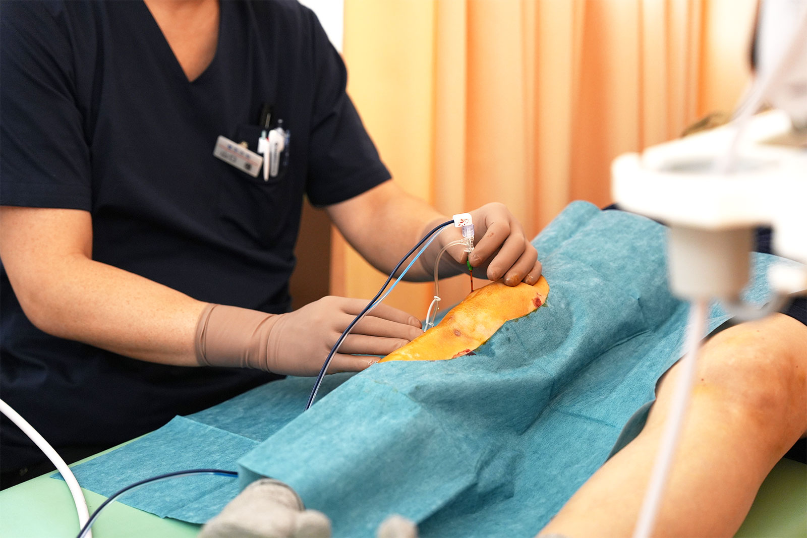 2.電極針の挿入